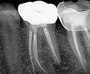Case-Study-1-Post-Op-2-1.jpg Case-Study-1-Post-Op-2-1.jpg