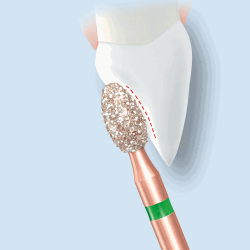 03di_KP6379_Frontzahn_601.png